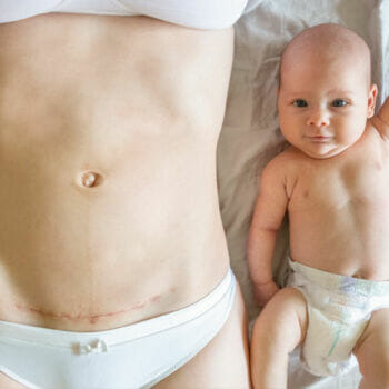 Kaiserschnitt Geburt und Kaiserschnittnarbe