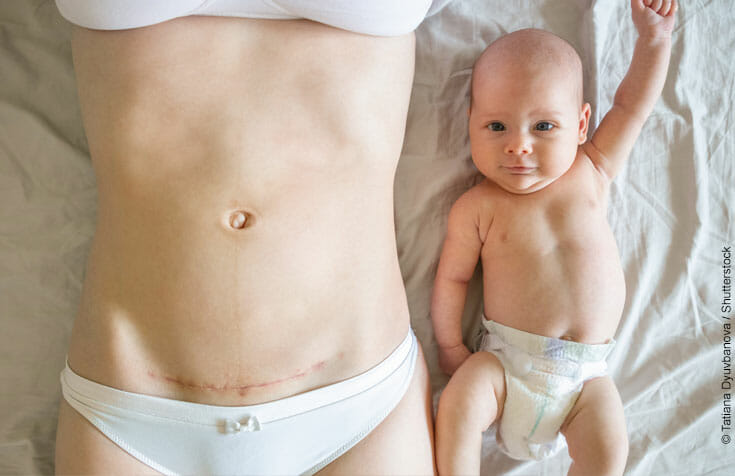 Kaiserschnitt Geburt und Kaiserschnittnarbe